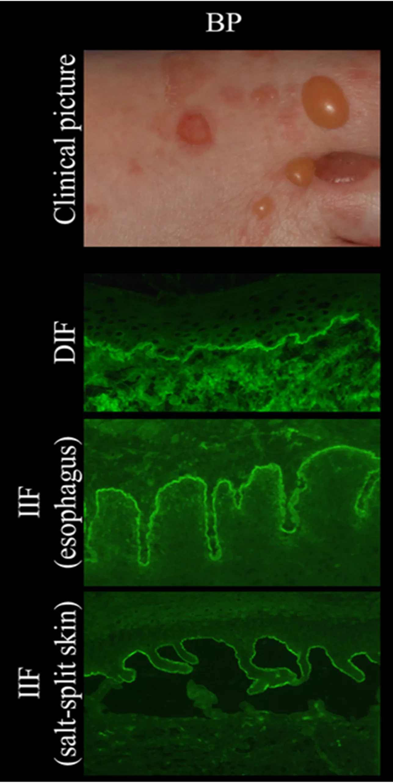 Clinical and immunopathological characteristics in bullous pemphigoid