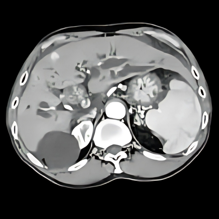 CT Scan showing Cholangiocarcinoma,