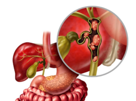 cholangiocarcinoma