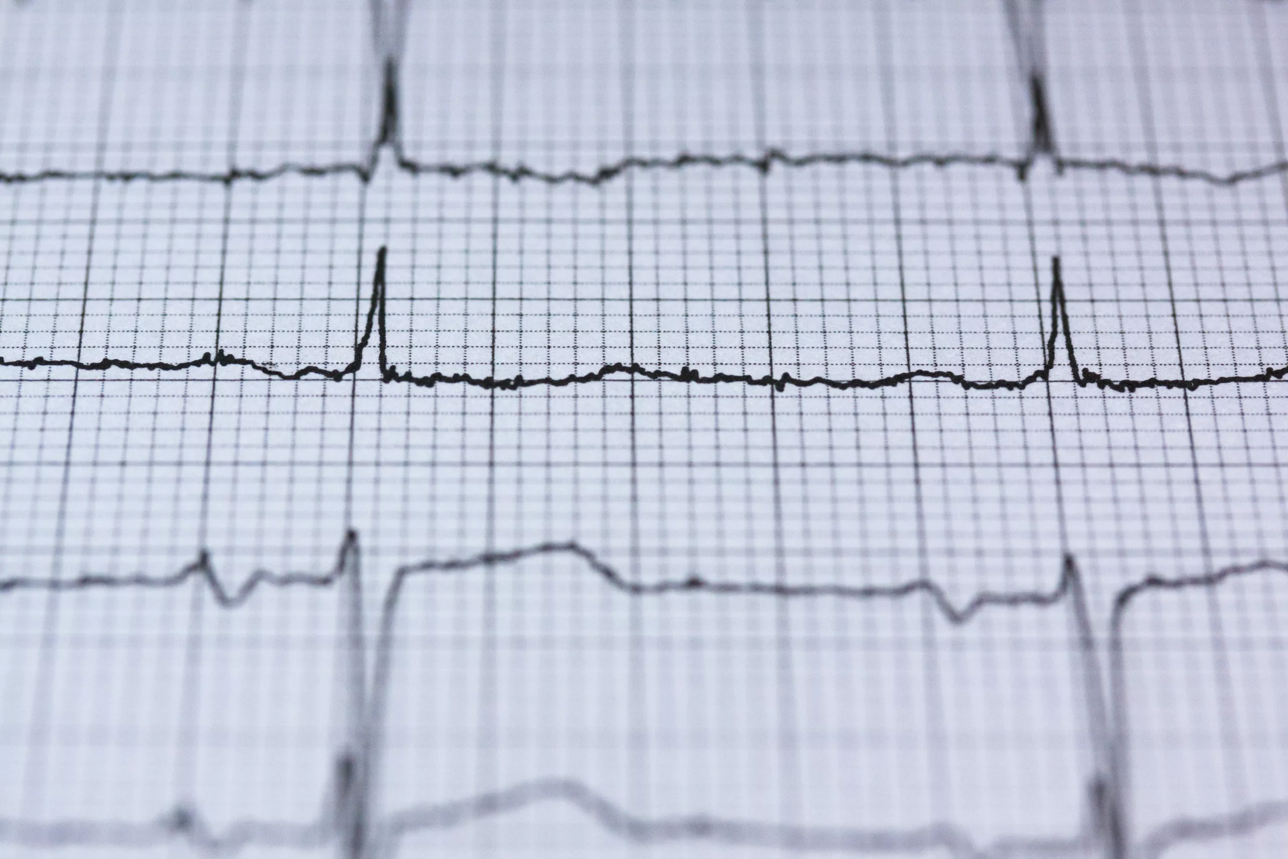 ECG helps identify cardiac myopathies in IOPD.