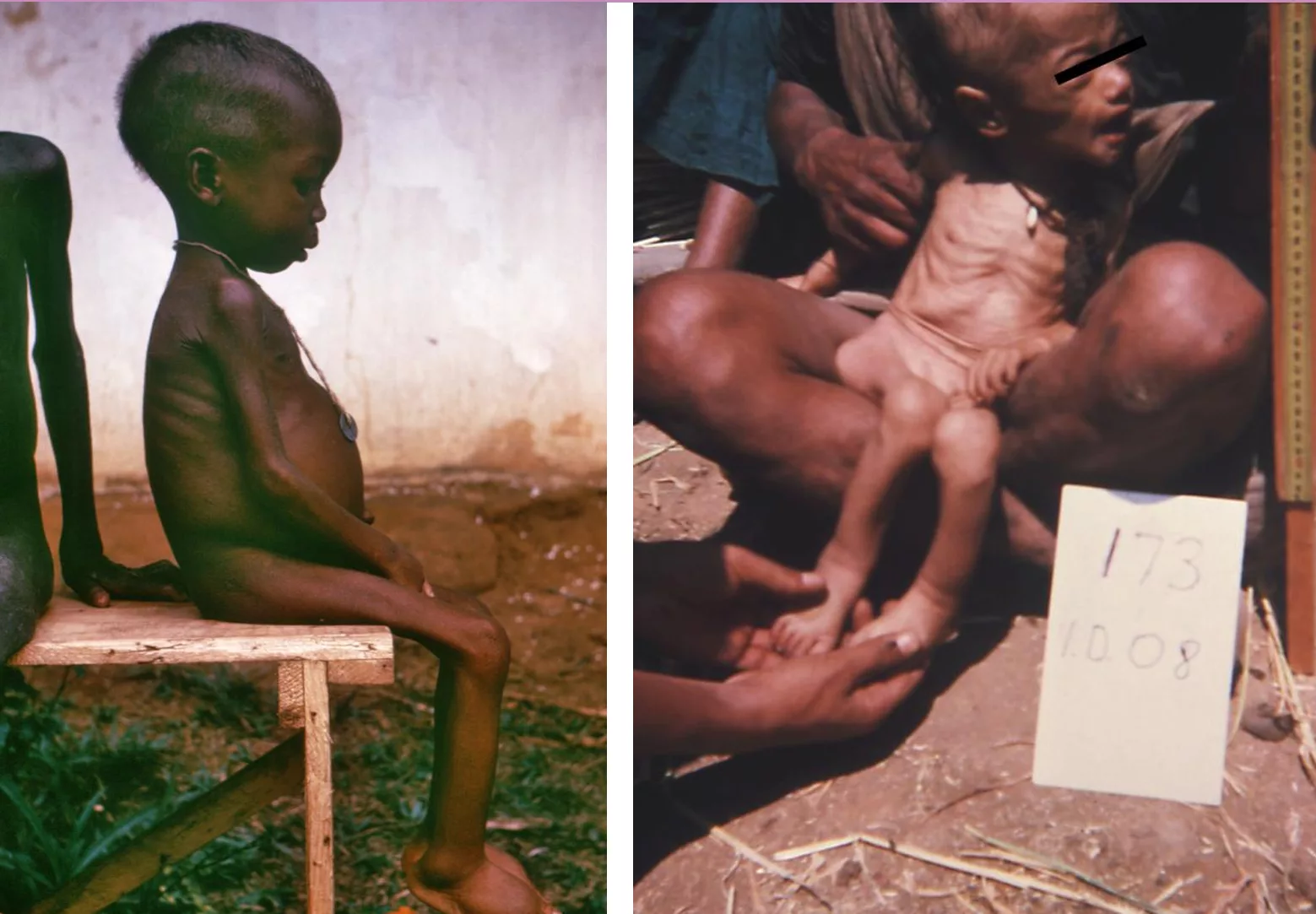This image shows the difference between a child with kwashiorkor and marasmus