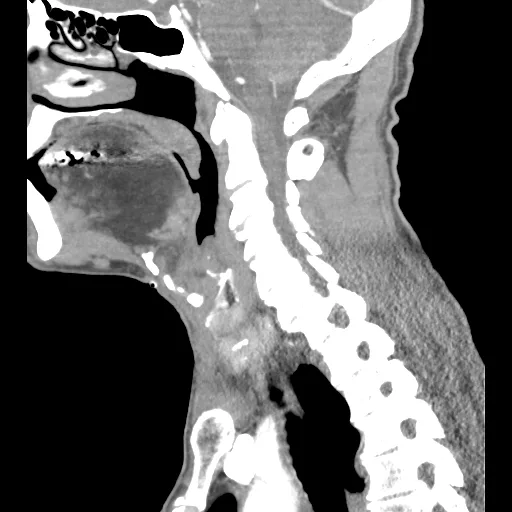 Symptoms of Pompe disease in adults