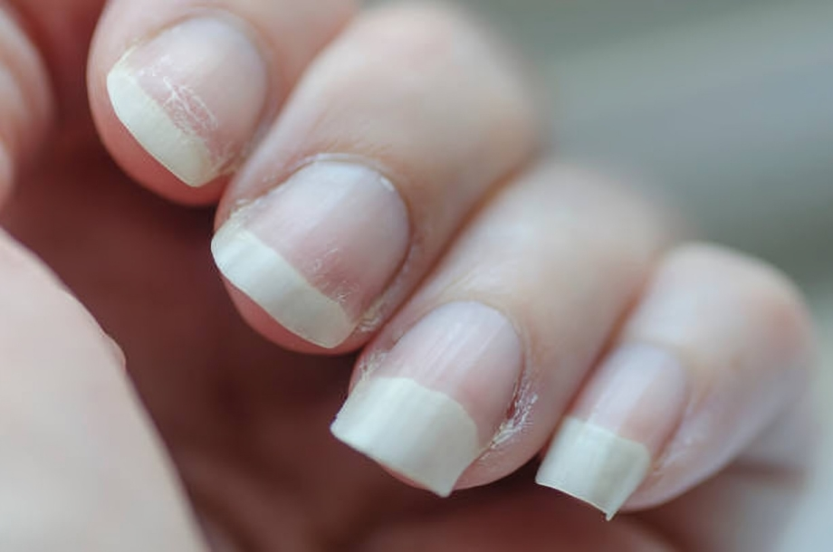 Brittle nails due to omega-3 deficiency