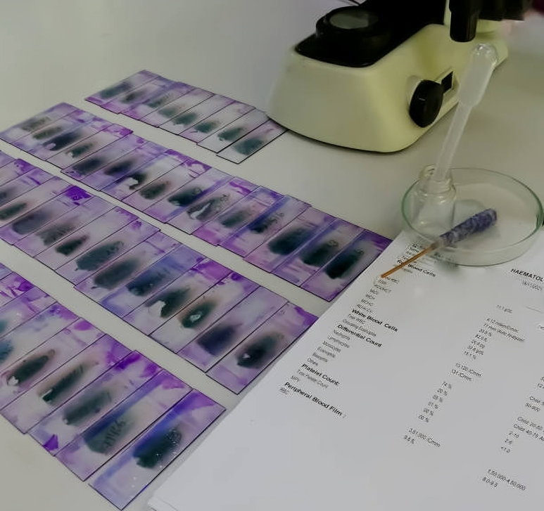 Stained glass slides of peripheral blood smear ready for microscopic examination