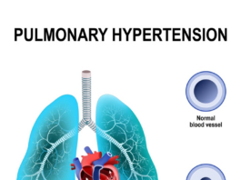 Primary Pulmonary Hypertensionr