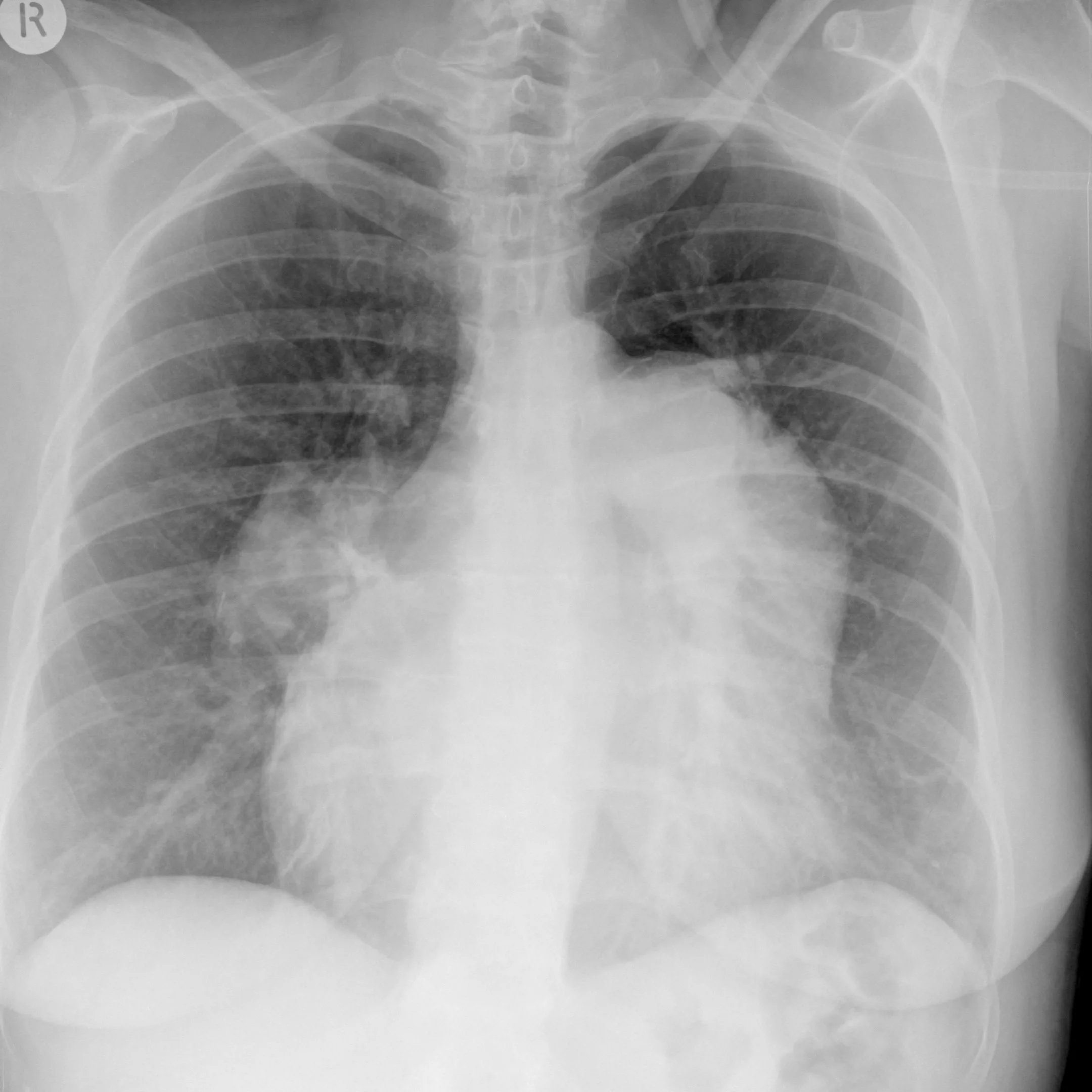 X-Ray shows massive enlargement of the pulmonary trunk and the right and left main pulmonary arteries. 