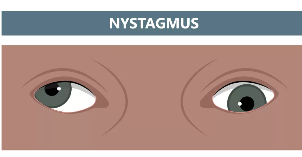 Congenital Nystagmus