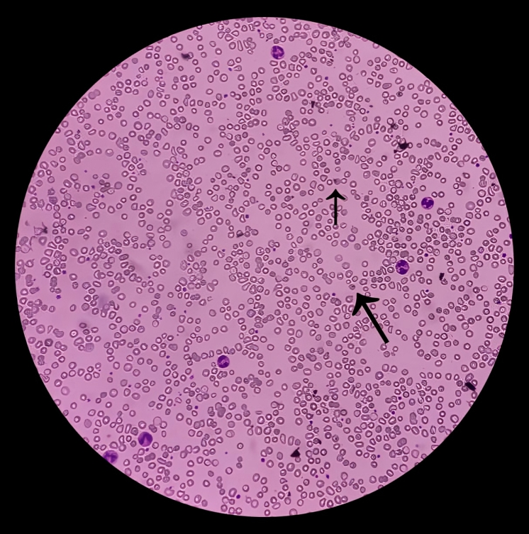 Blood smear showing spherocytes and target cells