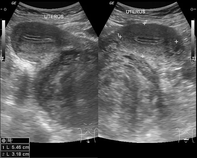 A large solid mass lesion is seen displacing the uterus anteriorly. 