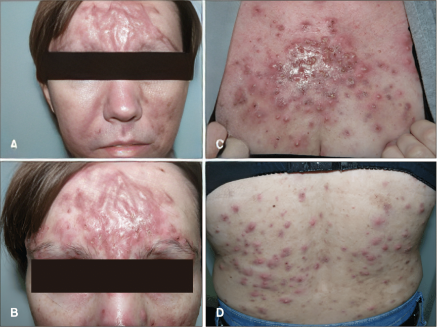 Acne conglobata lesions with pronounced scarring on the face 