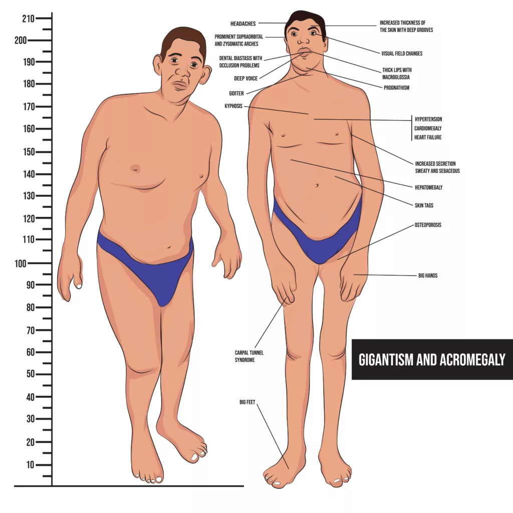 Illustration showing signs and symptoms of gigantism