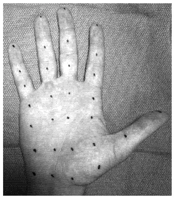 Pattern marking for Botox injection