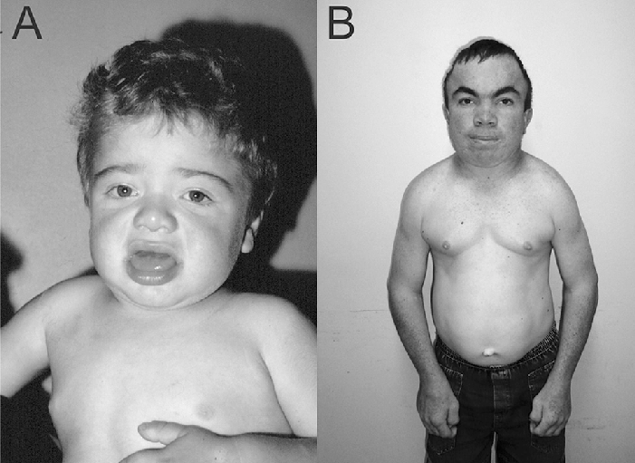 A: a 2-year-old with a severe phenotype for hunter syndrome; B: an adult male with an attenuated phenotype