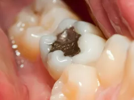 Dental Fillings