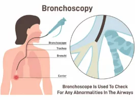 Image showing bronchoscopy