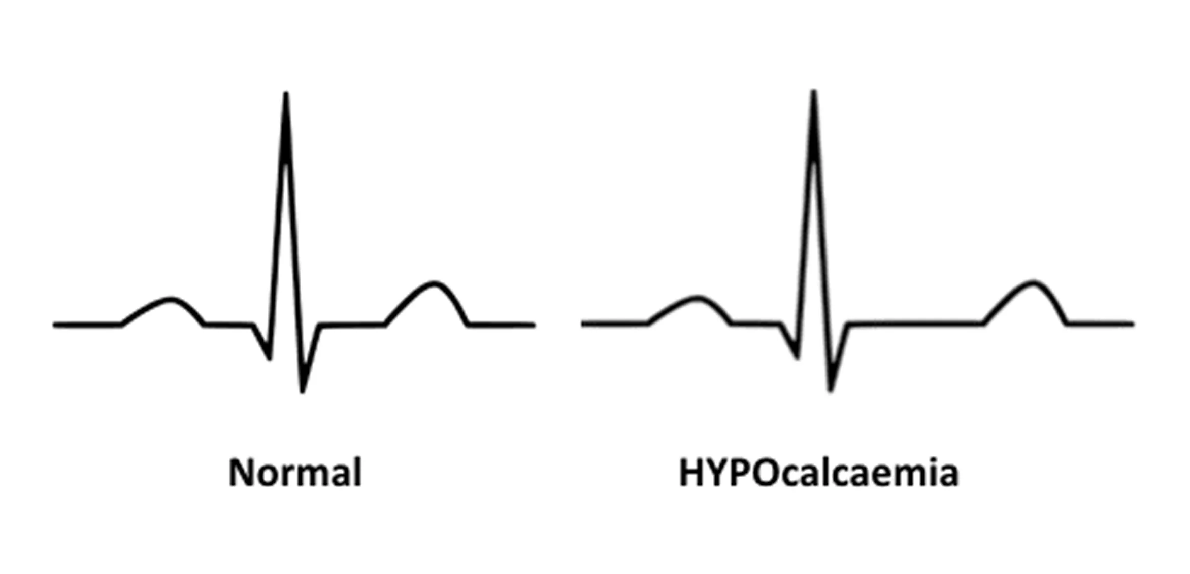 ECG in Hypocalcemia 