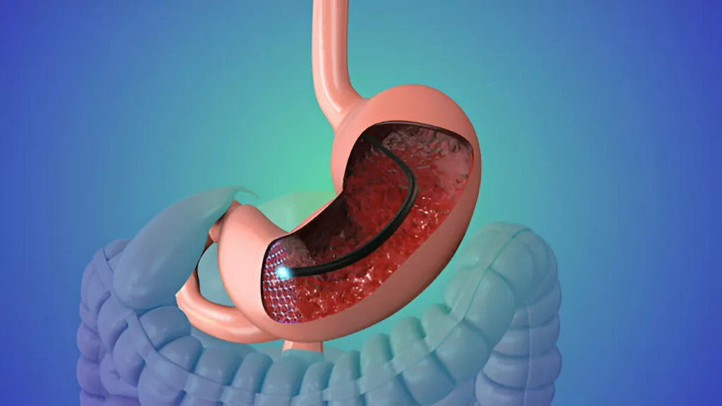 Image of stomach endoscopy