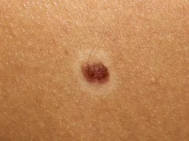 Halo Nevus