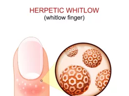 herpetic whitlow