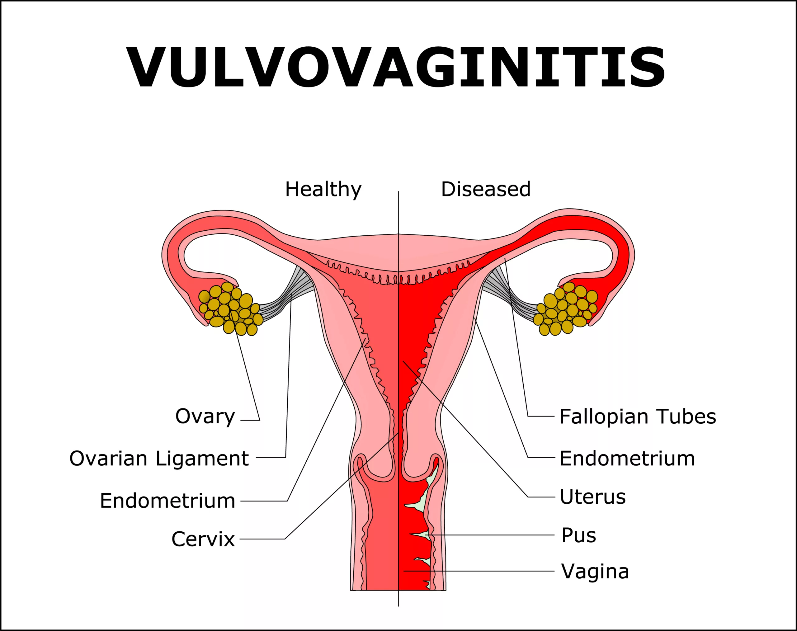 Vulvovaginitis