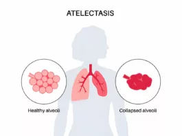 atelectasis