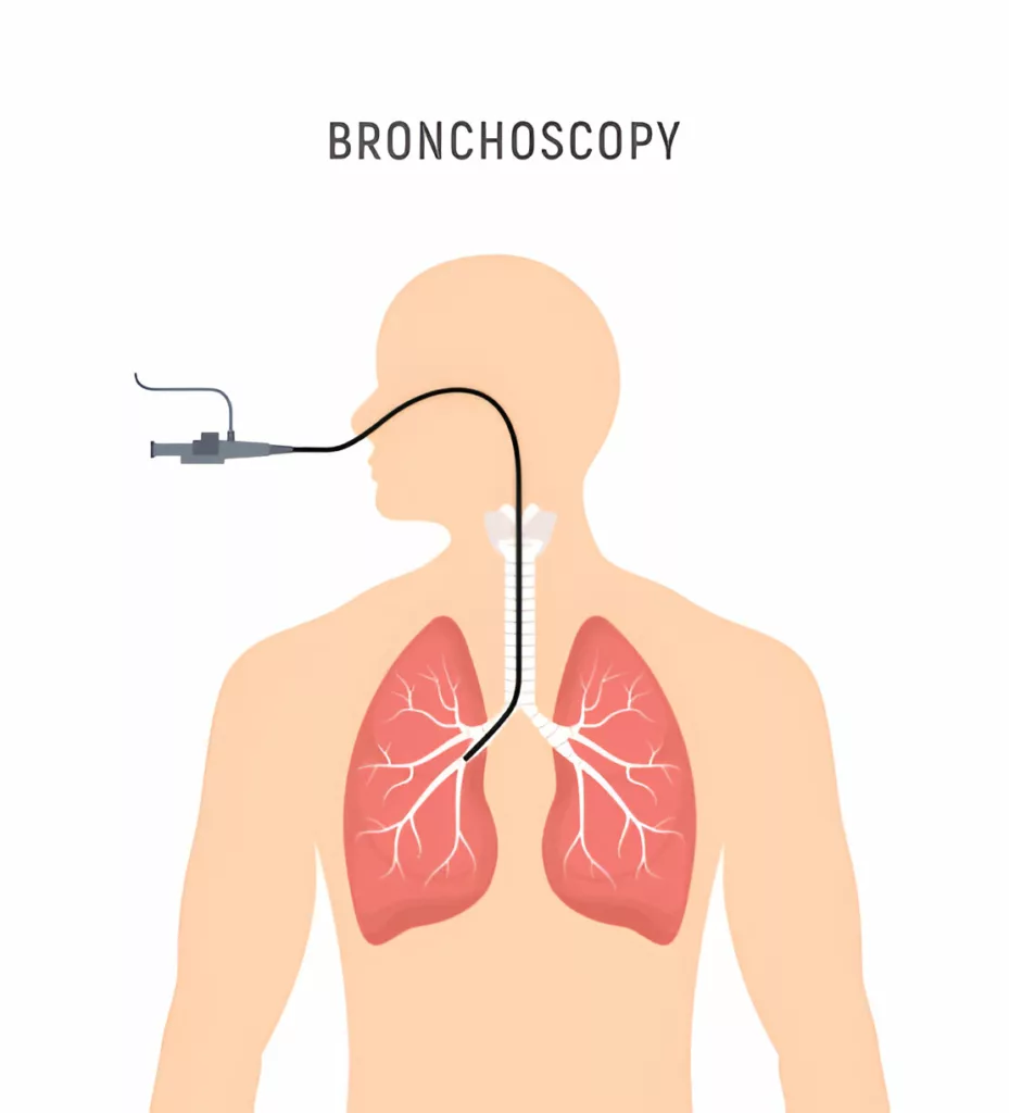 Bronchoscopy 