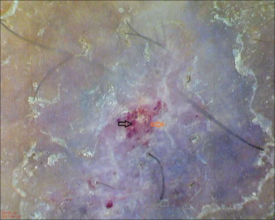 Dermoscopic view of a prurigo nodularis lesion.