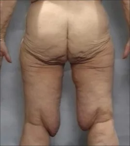 Saggy skin in weightloss patient.