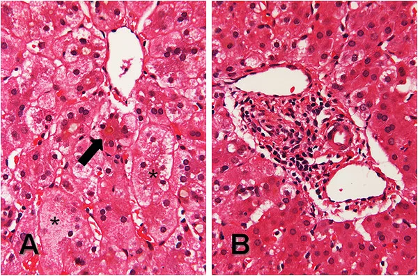 A liver biopsy at nine weeks showed findings consistent with Alagille syndrome