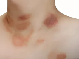 Pityriasis rosea