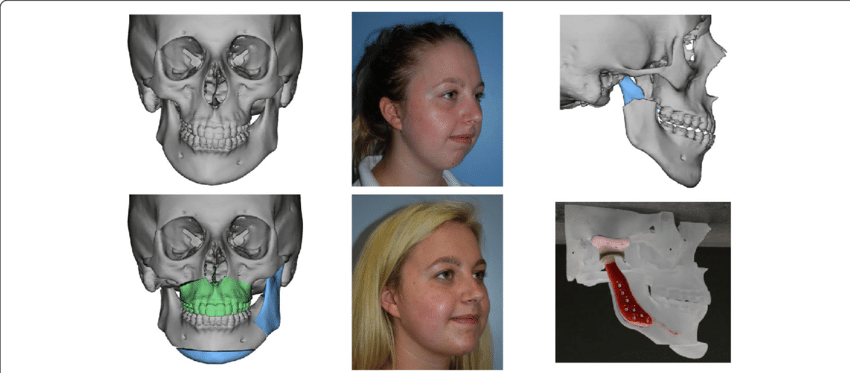 Pre- and postoperative images of a patient with mandibular asymmetry