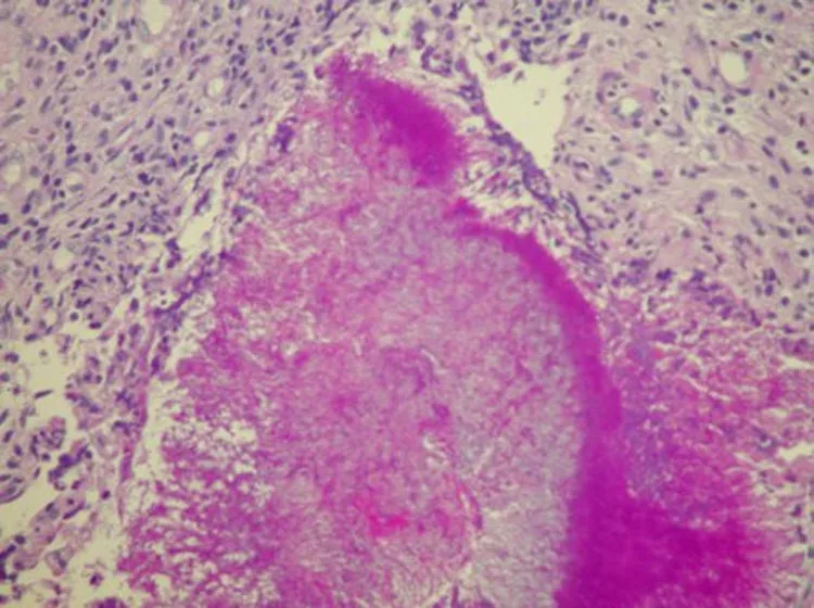 Sulfur granules in actinomycosis