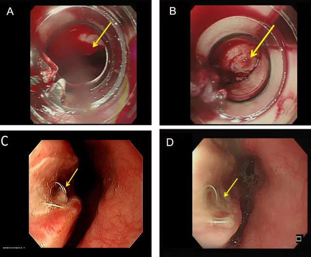 An image describing the images taken through an EGD