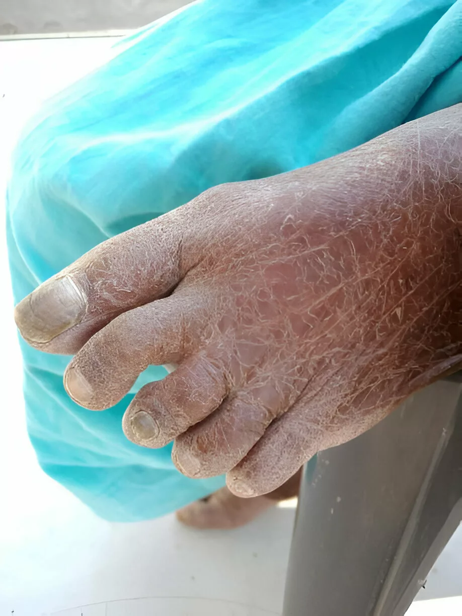 Scales on the foot of patient suffering from ichthyosis vulgaris
