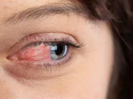 Ocular Rosacea