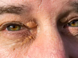 Xanthelasma