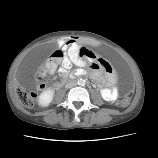 CT scan of pelvic actinomycosis