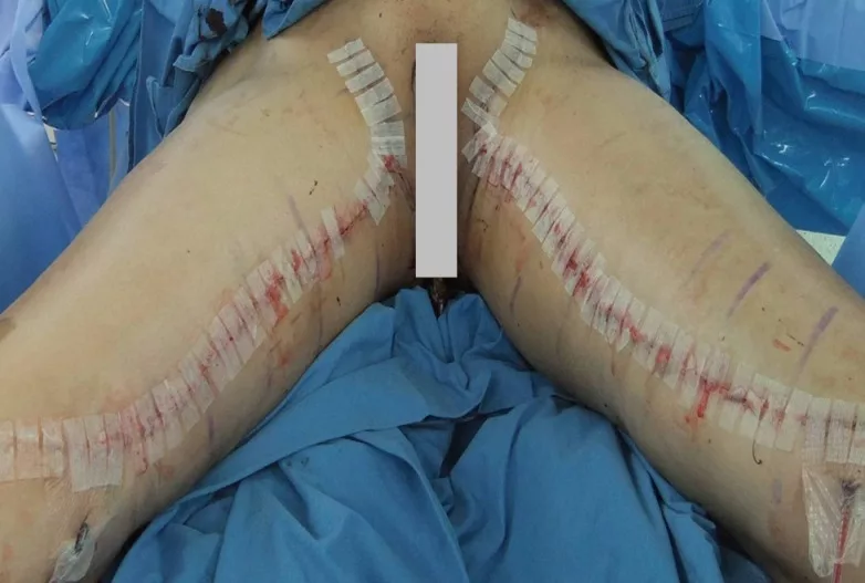 Immediate post-operative view after thigh lift.