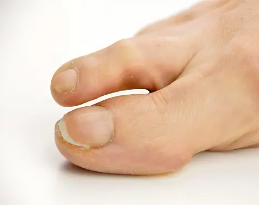 Foot with calluses formation