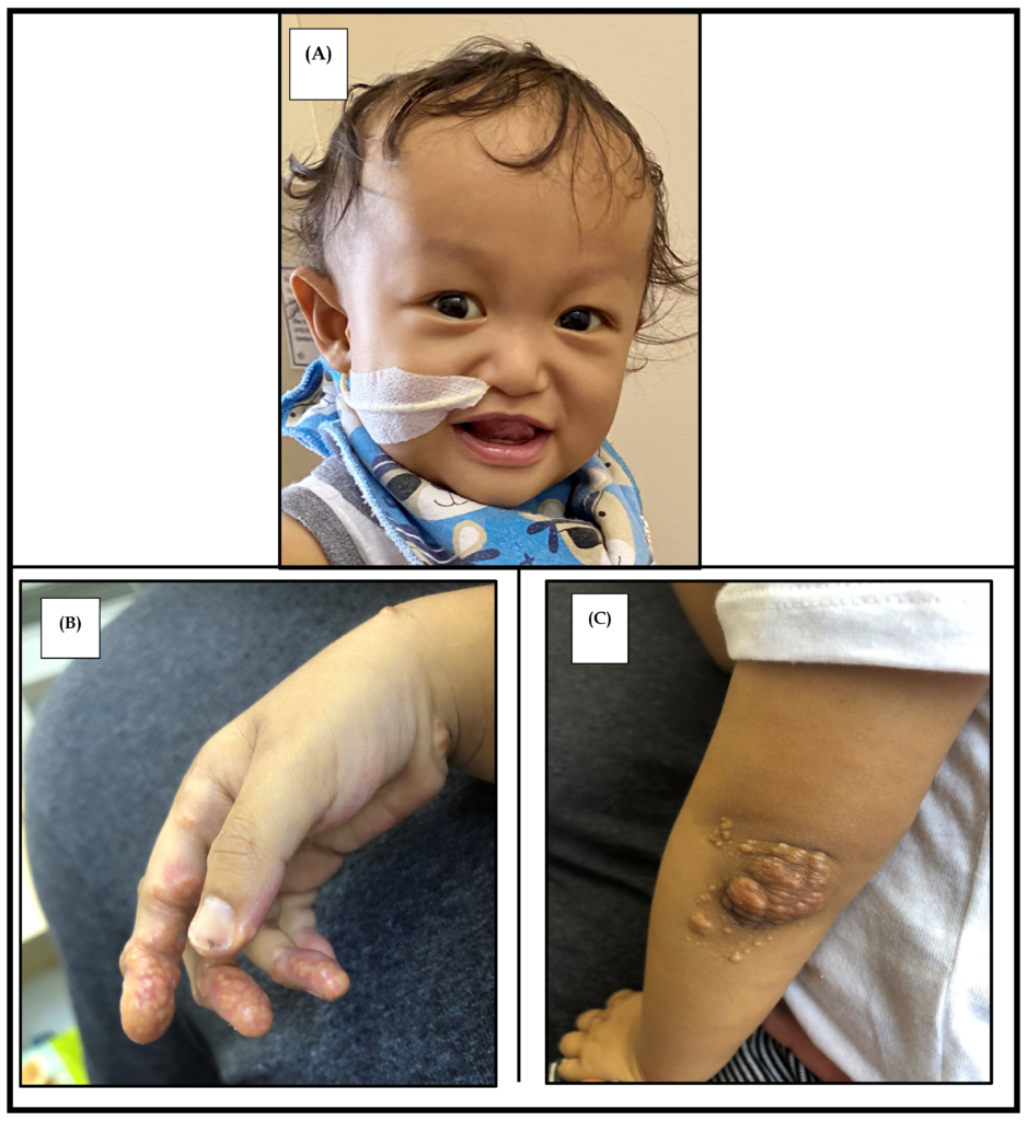 Clinical features of Alagille syndrome