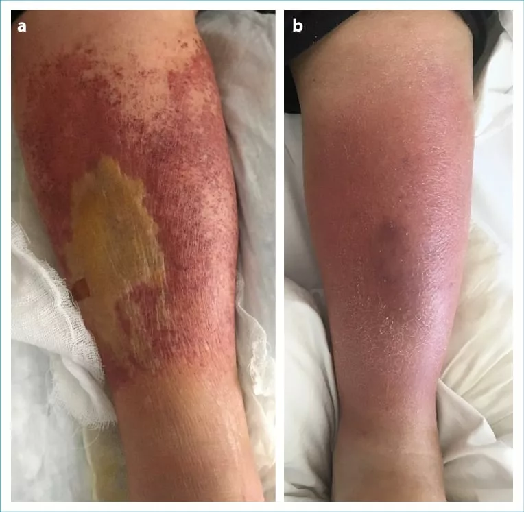 figure a showing erysipelas lesion and figure b showing cellulitis