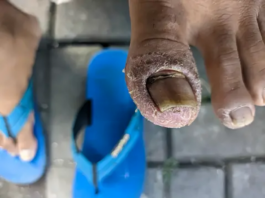 Skin and nail affected by pachyonychia congenita