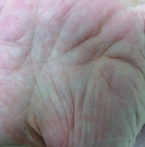 hand of patient with hyper linearity