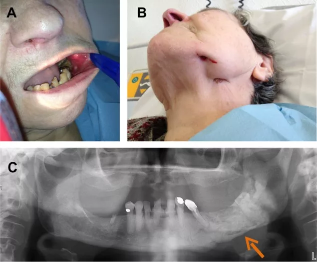 Actinomycosis-induced osteomyelitis of the jaw