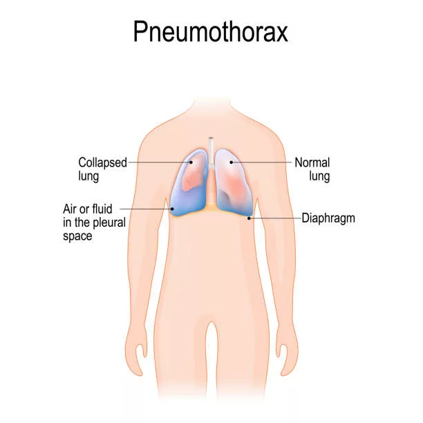 Abnormal collection of air (pneumothorax) or fluid (pleural effusion) or pus (empyema) in the pleural space between the lung and the chest wall.