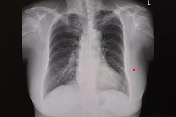 A chest xray of a patient showing a small plate atelectasis in the left lung.