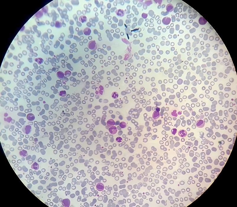 Macrocytosis, hypersegmentation of neutrophils, anisocytosis, poikilocytosis, macroovalocytes in megaloblastic anemia