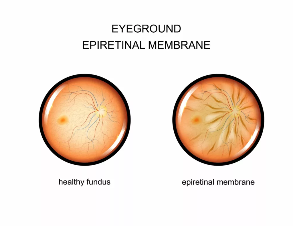 Figure on the left showing healthy macula and figure on the right showing presence of an epiretinal membrane over the macula 