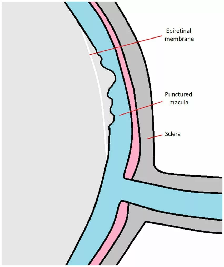 Figure 2 showing epiretinal membrane over the torn macula