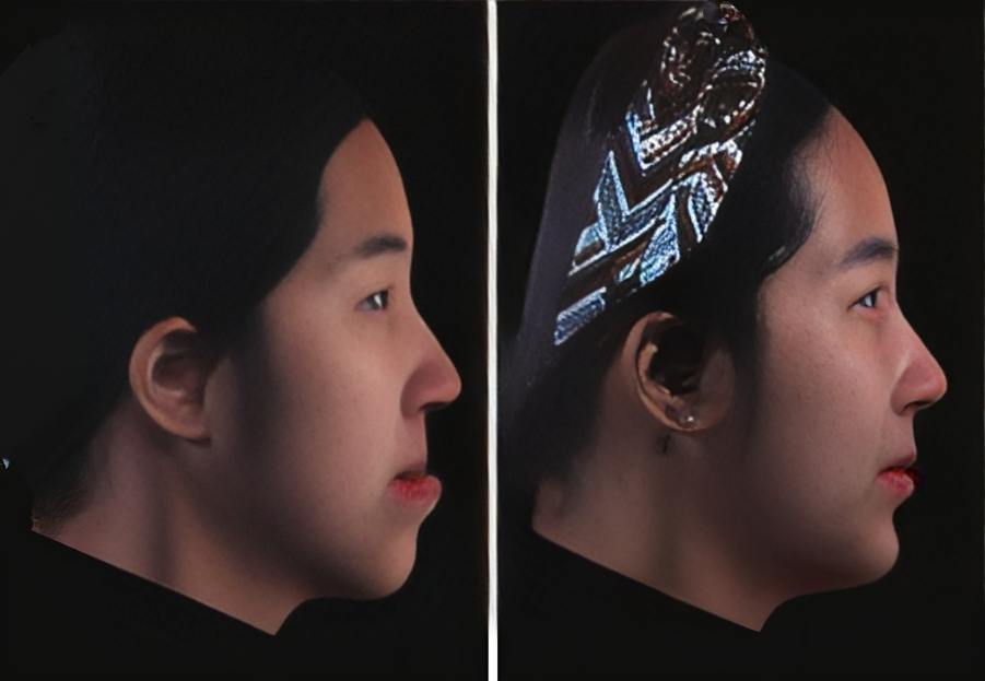 Three-dimensional profile views before (left) and after (right) orthognathic surgery 